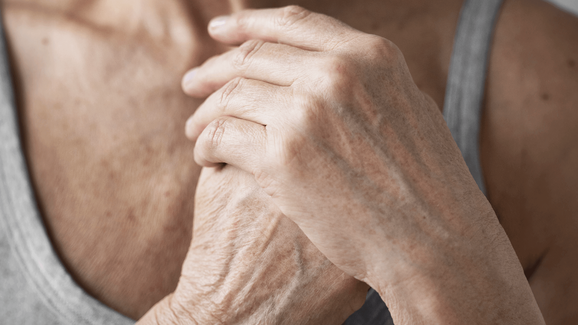 Manchas senis nas mãos: inofensivas ou preocupantes? Saiba tudo sobre