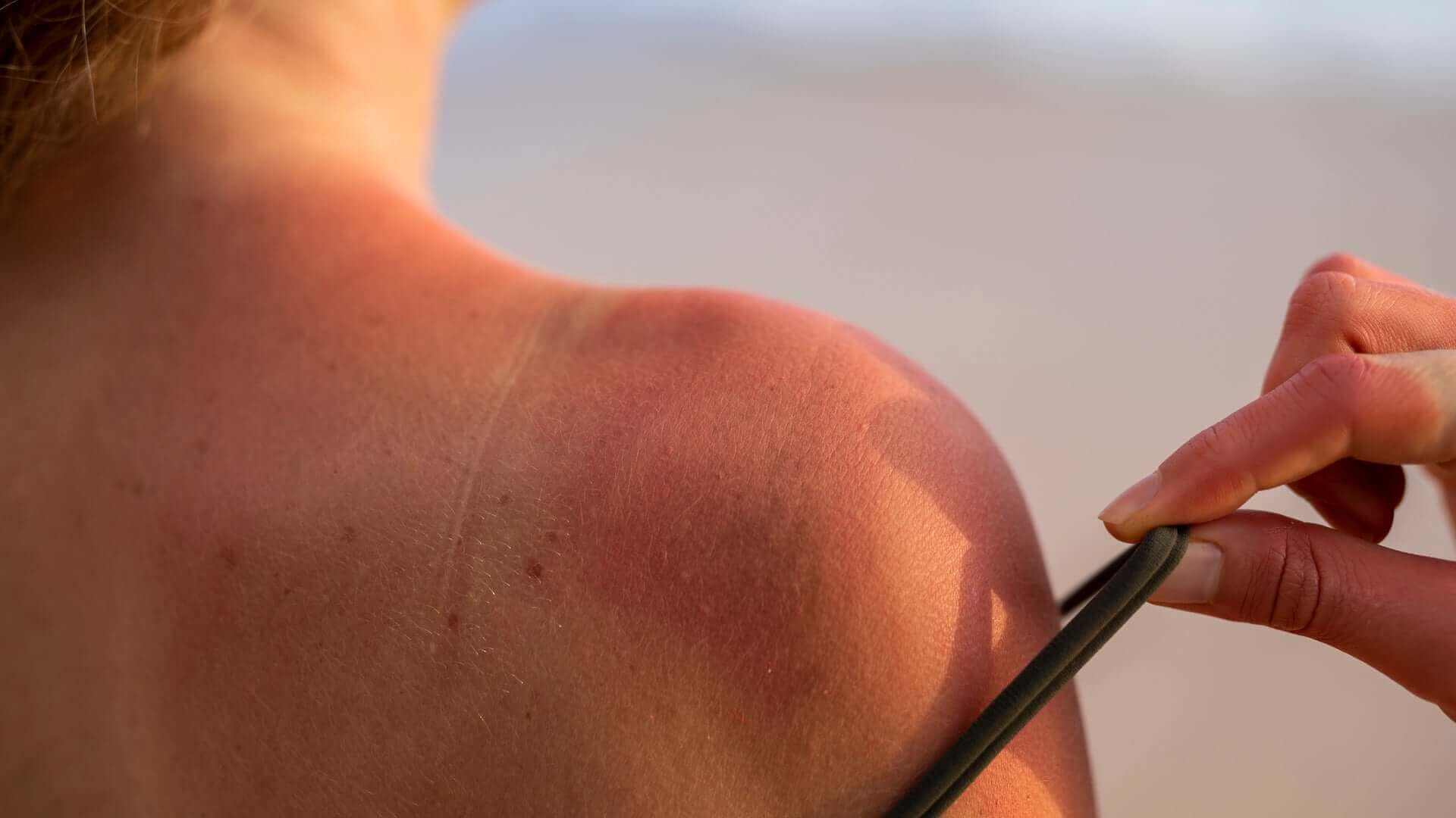 Pele bronzeada e pele queimada: quais as diferenças e cuidados