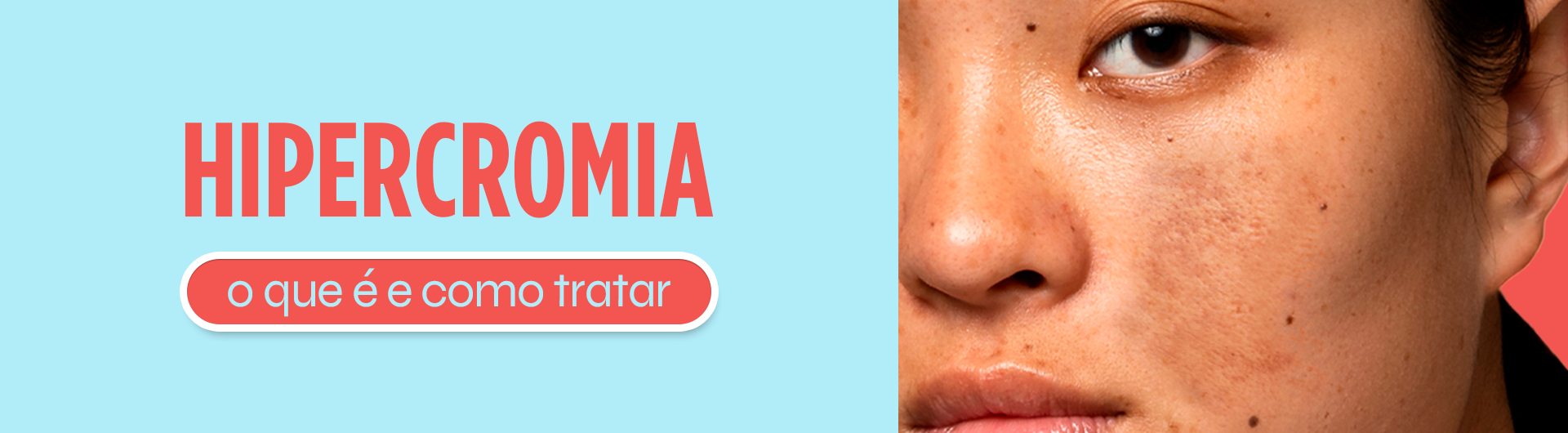 Hipercromia: O que é e como tratar