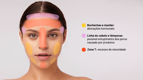 Acne e espinha: o que é, como cuidar e tratar. Descubra!