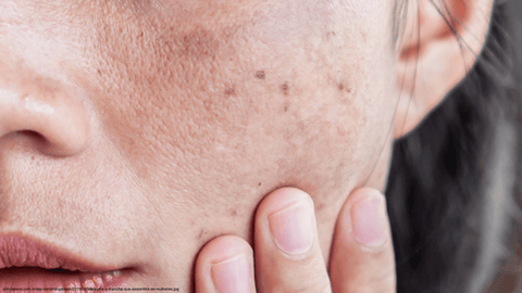 Melasma: como o protetor solar pode evitar e tratar
