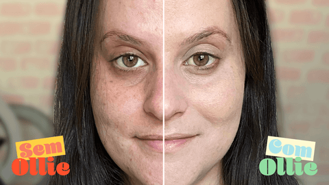 Melasma: como o protetor solar pode evitar e tratar