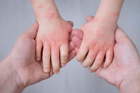 Dermatite infantil: quais os sintomas e como tratar